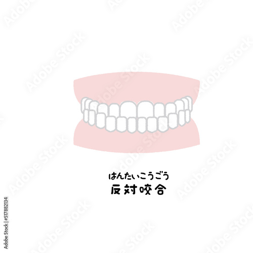 歯並び　イラスト　反対咬合