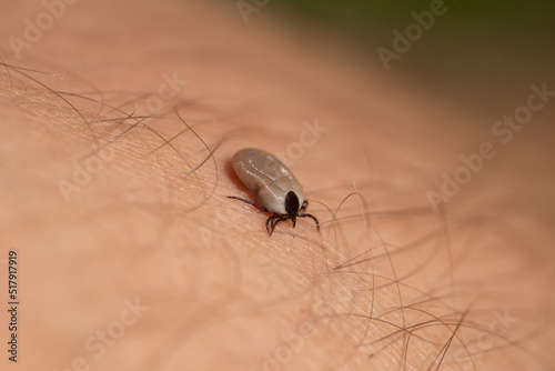 Tick filled with blood sitting on human leg skin. Ixodes ricinus or scapularis. Close-up of dangerous parasitic mite in dynamic motion. Diseases transmission as encephalitis. Macro photography