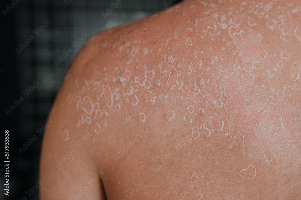 Fototapeta premium Dermatological conditions of peeling skin on man's back and shoulders, peeling skin and skin care concept. Close up