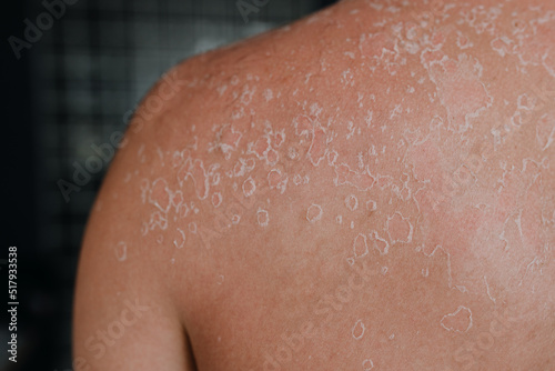 Dermatological conditions of peeling skin on man s back and shoulders  peeling skin and skin care concept. Close up