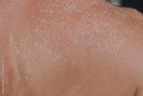 Skin texture background with flaking cell scales after sunburn and allergy on human body