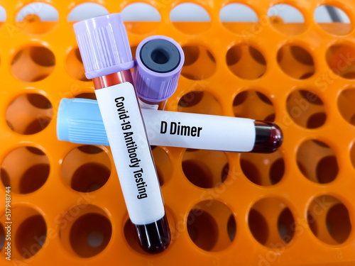 Blood sample for Covid-19 antibody and d dimer test. Biochemistry lab Close view. IgG, IgM test of Covid-19. photo