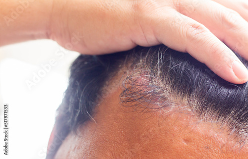 skin disease at the head, Dandruff is a common condition that causes the skin on the scalp to flake photo