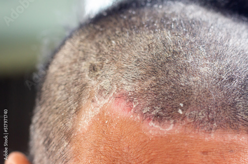 skin disease at the head, Dandruff is a common condition that causes the skin on the scalp to flake photo