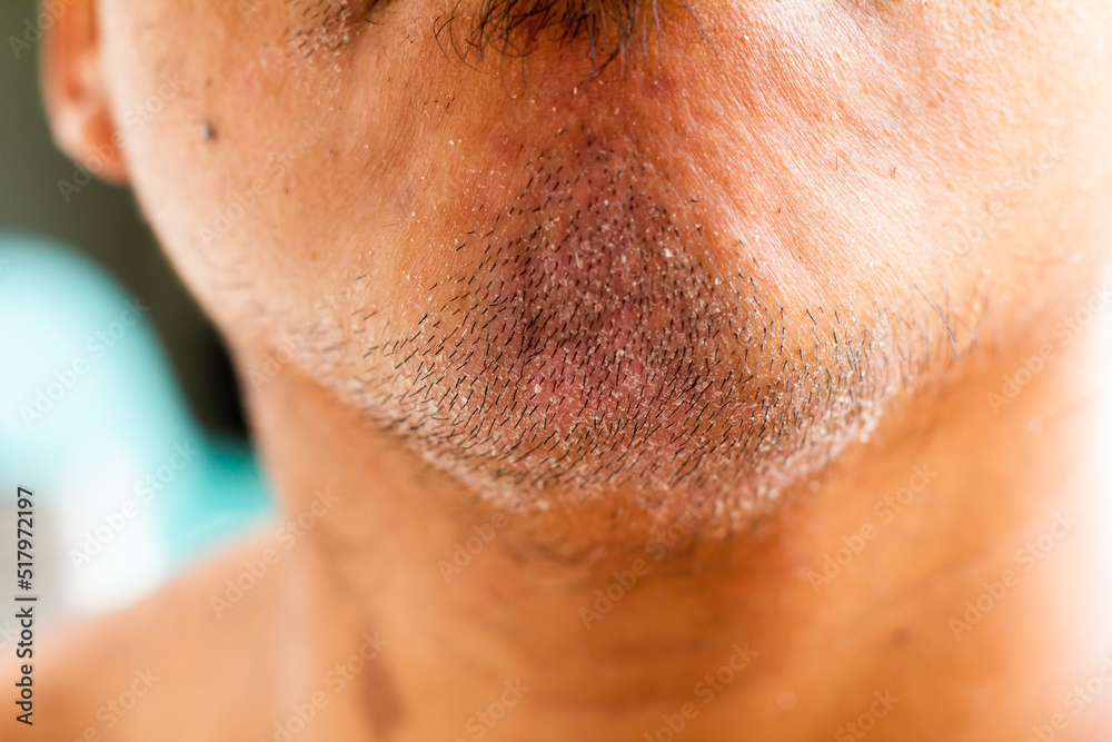 skin disease at the chin, Dandruff is a common condition that causes the skin on the chin to flake skin disease at the chin, Dandruff is a common condition that causes the skin on the chin to flake