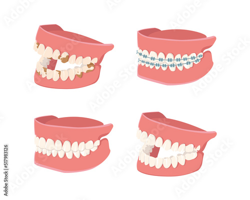 Human Jaw set isolated on white background. Opened, closed, jaws and jaws with braces. Dental model of human jaws. Healthy oral hygiene. Trendy graphic for stomatology, dentist. Vector illustration