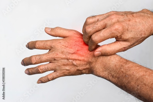 Asian man scratching his hand. Concept of itchy skin diseases such as scabies, fungal infection, eczema, psoriasis, allergy, etc.
