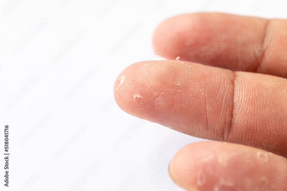 Pattern of Atopic eczema and fungal diseases on the human body. Pattern of Atopic eczema and fungal diseases on the human body.