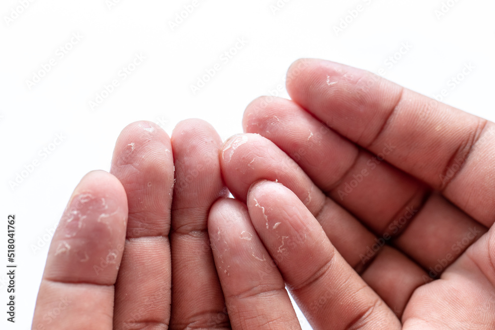 Pattern of Atopic eczema and fungal diseases on the human body. Pattern of Atopic eczema and fungal diseases on the human body.