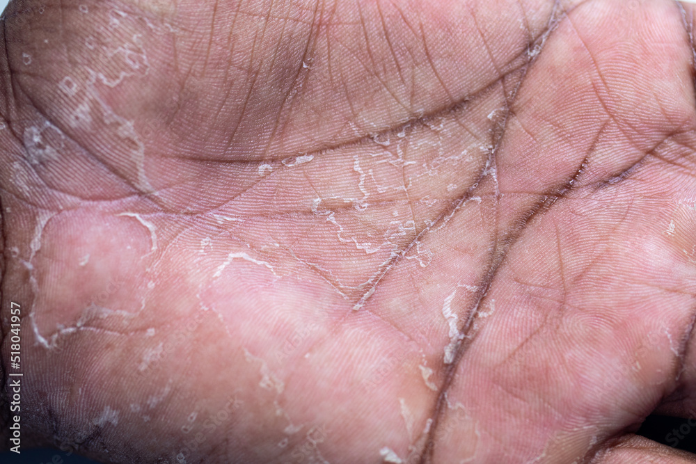 Pattern of Atopic eczema and fungal diseases on the human body.