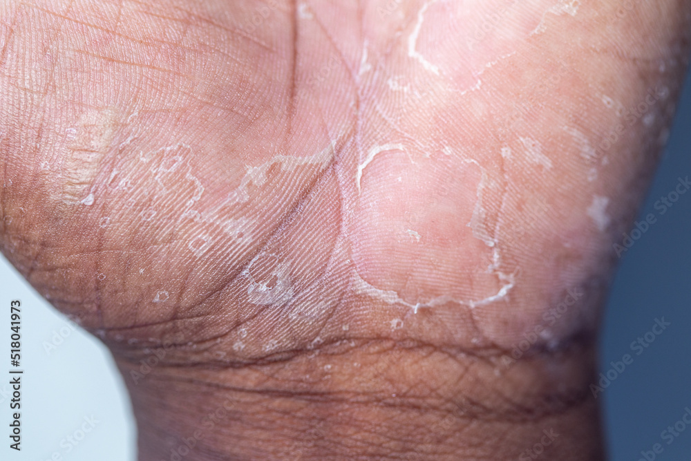 Fototapeta premium Pattern of Atopic eczema and fungal diseases on the human body.