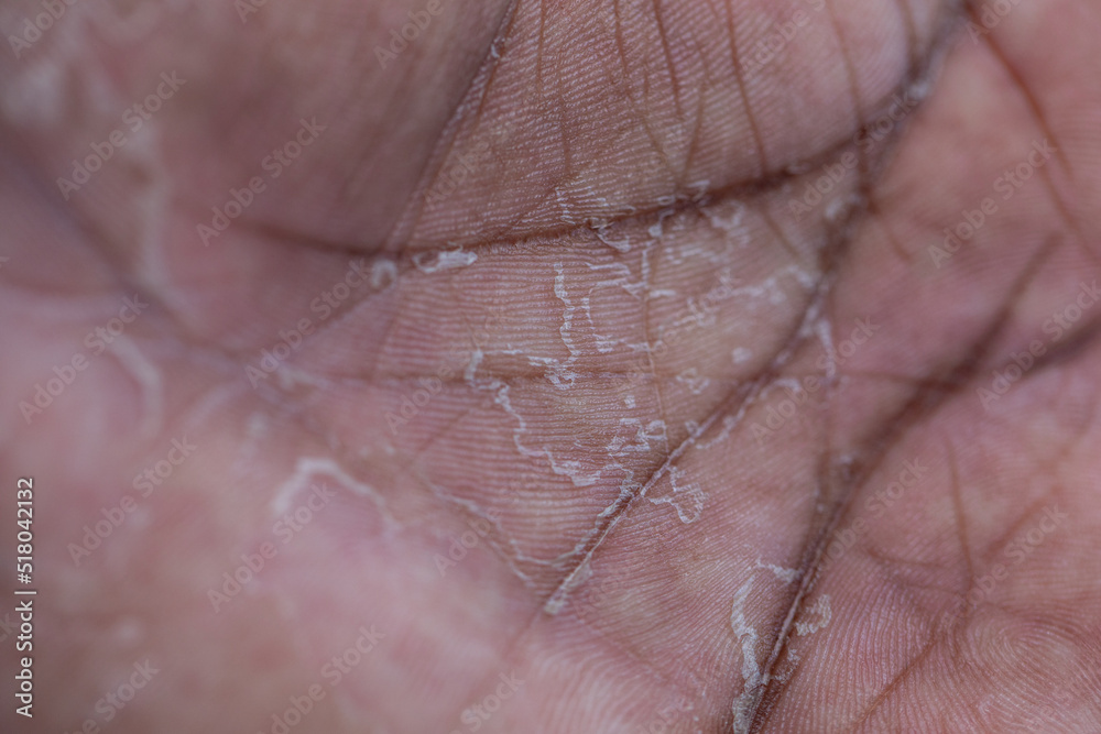 Pattern of Atopic eczema and fungal diseases on the human body. Pattern of Atopic eczema and fungal diseases on the human body.