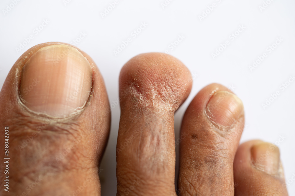 Pattern of Atopic eczema and fungal diseases on the human body. Pattern of Atopic eczema and fungal diseases on the human body.