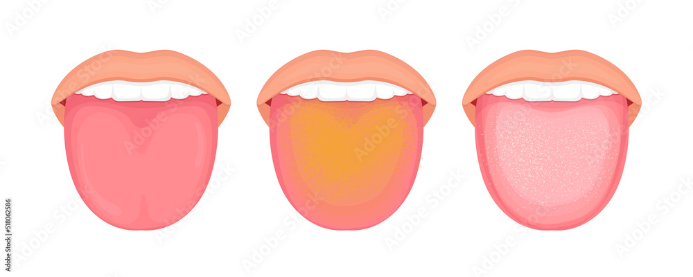 Illustration of tongue symptoms and health. medical illustration. Illustration of tongue symptoms and health. medical illustration.