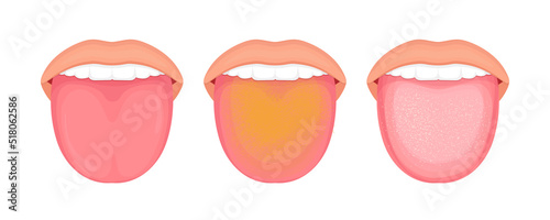 Illustration of tongue symptoms and health. medical illustration.
