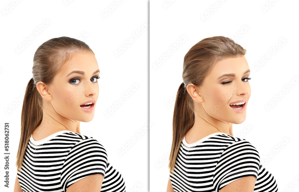 Thinning hair and hair loss,female pattern baldness,Hair transplant