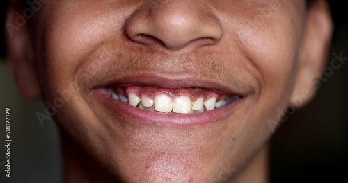 Pre-teen young boy smiling, close-up child mouth teeth