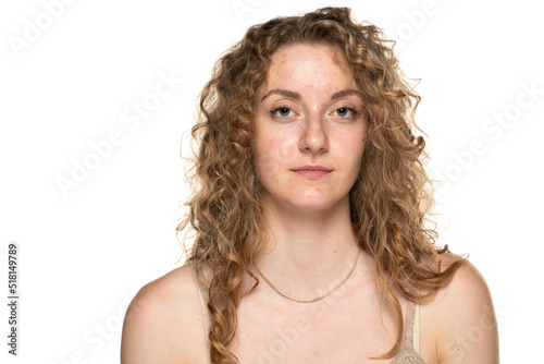 beautiful young blond women with long curly hair and problemati skin