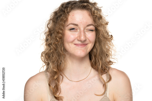 Winking blond women with long curly hair and problematic skin