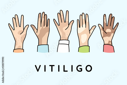 Diverse hands of people suffer from vitiligo disease. People struggle with pigmentation on body. World vitiligo day concept. Vector illustration. 