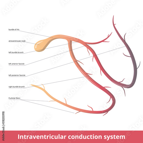 Intraventricular (electrical) conduction system of the heart transmits signals generated by the sinoatrial node to cause contraction of the heart muscle:  atrioventricular nod Purkinje fibers photo