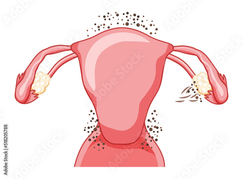 Endometriosis stage 1 Female reproductive system pain uterus. Front view. Human anatomy internal organs location scheme flat style icon vector illustration Realistic flat color concept isolated white