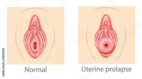 Set of uterine prolapse Female reproductive system women perineum uterus normal and with disease pain. Human anatomy external organs flat style icon. Vector medical illustration concept isolated