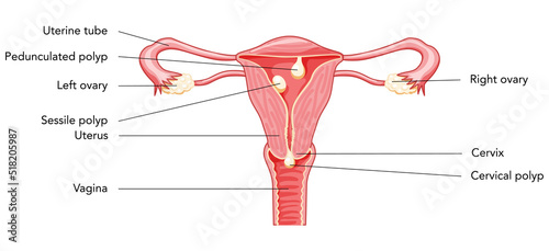Polyp in the uterus with inscriptions diagram Female reproductive system in cross sections. Front view in a cut. Human anatomy diseases internal organs location scheme, cervix, ovary flat style icon