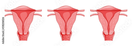 Set of Cervical cancer Dysplasia stages infographic Female reproductive system Carcinoma uterus. Front view in a cut. Human anatomy internal organs location scheme, fallopian tube flat style icon