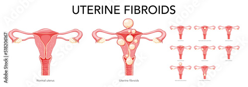 Set of Uterine fibroids Female leiomyomas reproductive system uterus normal and with disease. Human anatomy medical illustration isolated internal organs cervix, ovary, fallopian tube flat style icon photo