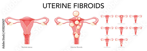 Set of Uterine fibroids Female leiomyomas reproductive system uterus normal and with disease. Human anatomy medical illustration isolated internal organs cervix, ovary, fallopian tube flat style icon