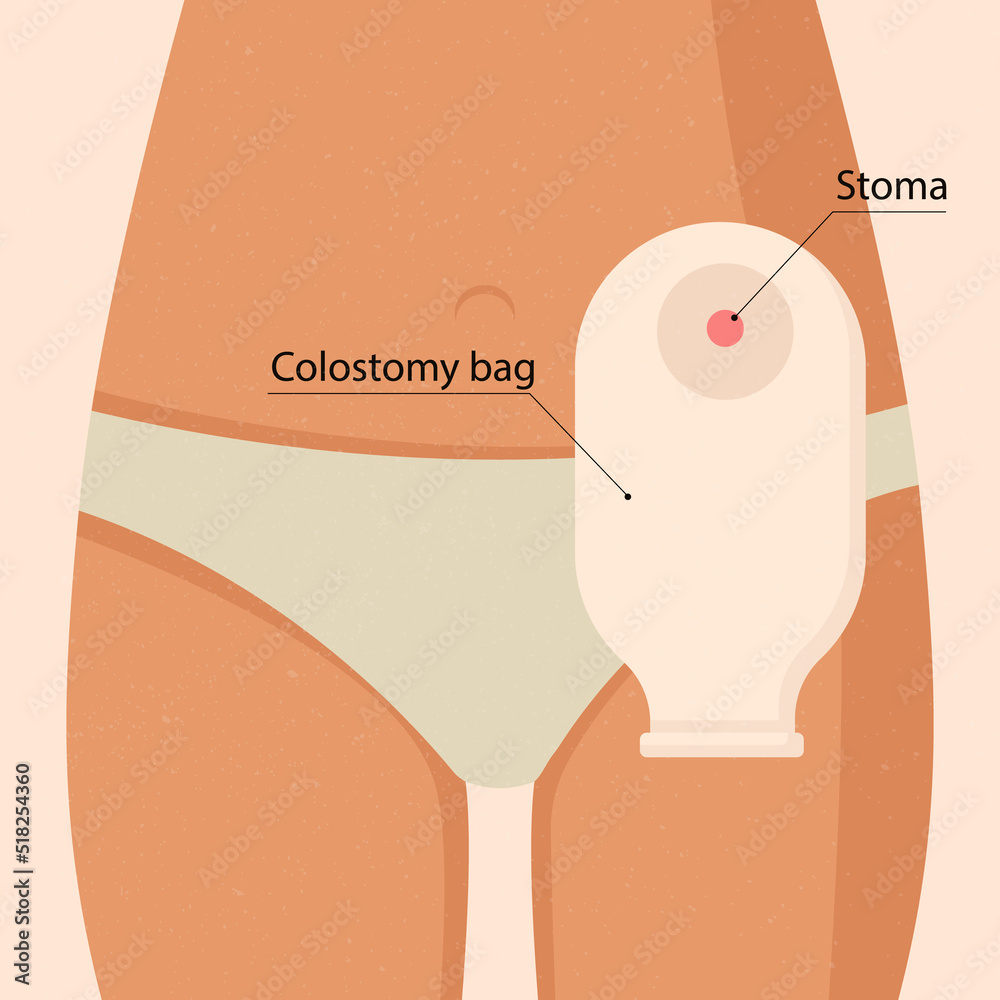 Choosing an Ostomy Pouch Made Easy | Vitality Medical