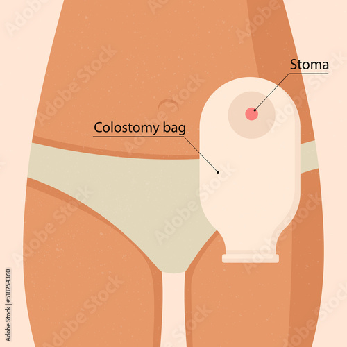 Colostomy bag stoma ostomy patient. cartoon vector illustration of a ostomy bag. A patient with a colostomy bag. Young woman with colostomy bag