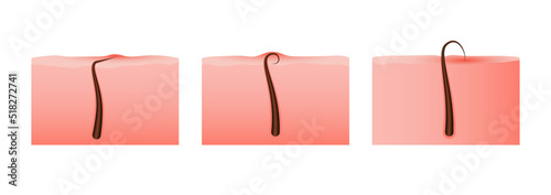 Hair growth cycle. Scheme of hair follicle with development from skin