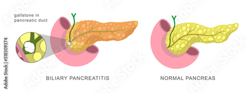 Acute pancreas inflamation caused by the obstruction of the pancreatic duct with stones. Biliary pancreatitis. Disease diagnostic procedure illustration. 