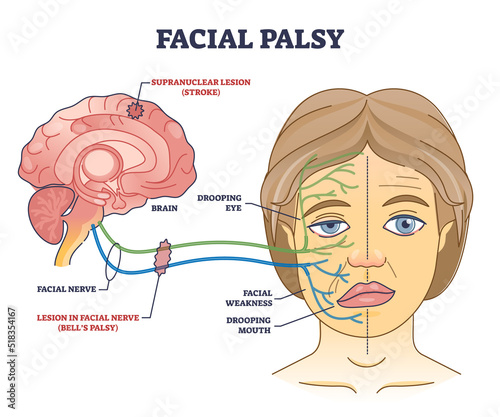 Facial palsy and muscles weakness because of nerve damage outline diagram. Labeled educational scheme with anatomical brain supranuclear stroke caused dropping mouth and eye vector illustration. photo