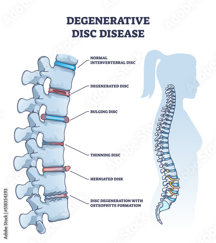 Degenerative disc disease with spine and vertebra trauma outline diagram. Labeled educational normal intervertebral, degenerated, bulging, thinning and herniated problem example vector illustration.