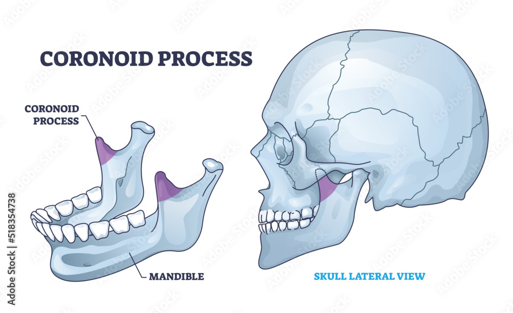 Coronoid Process Of Mandible