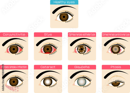 眼にまつわる病気の図解した素材／Illustrated material for eye diseases