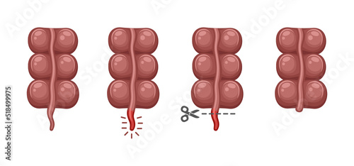 Inflammation and Removal Appendix Icons Set. Vector
