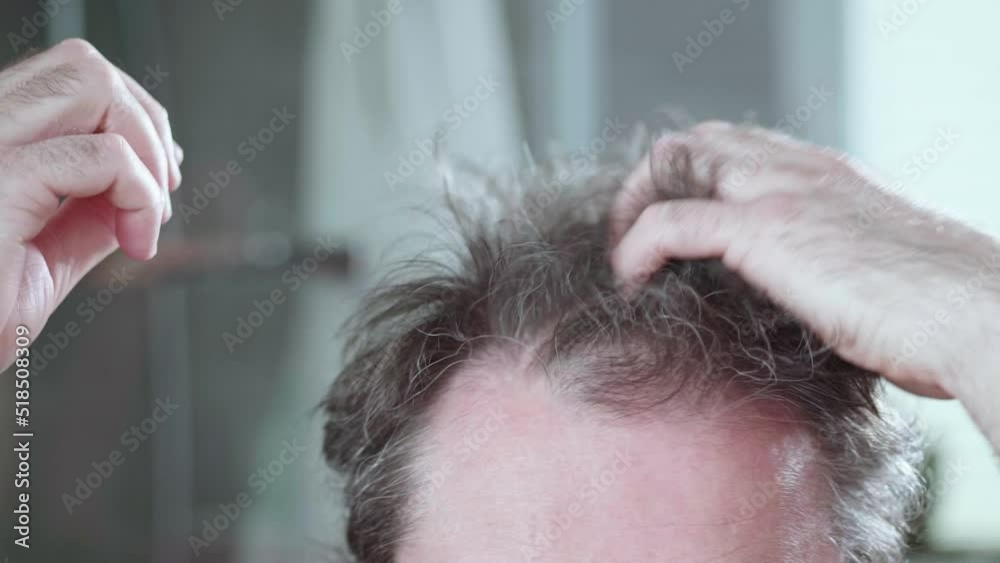 Thinning hair, the problem of hair loss and alopecia. Guy's crazy haircut. Thinning hair, the problem of hair loss and alopecia. Guy's crazy haircut.