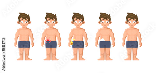 Inflammation and Removal Appendix Icons Set. Vector