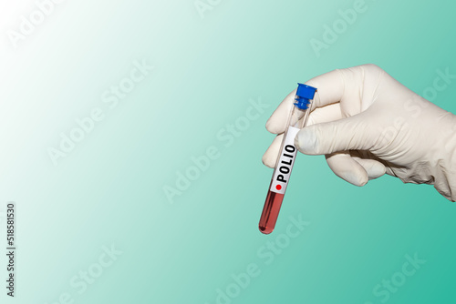 Polio virus. The doctor's hand holds a blood sample of an infected polio. An outbreak of poliomyelitis. photo