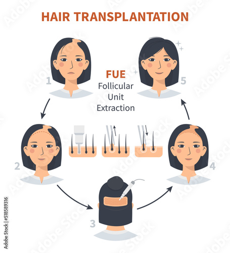 Stages of woman hair transplantation FUE Follicular Unit Extraction. Treatment of baldness, alopecia and hair loss. Vector medical infographics, a female head scalp. Strip, graft machine.