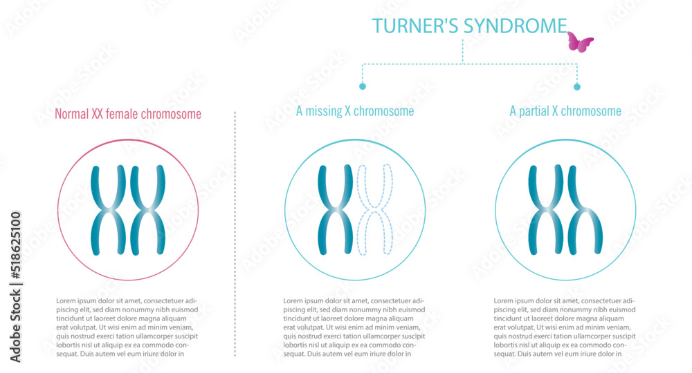 Turner syndrome, representation of XX chromosomes with total or partial