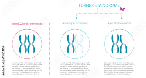 Turner syndrome, representation of XX chromosomes with total or partial lack of X. photo