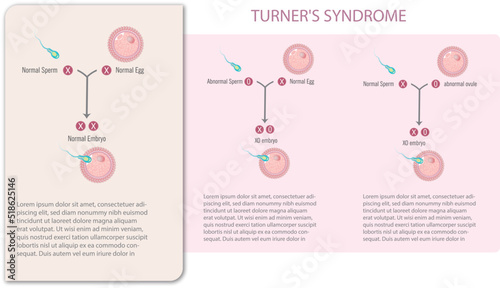 Infographic of sperm and egg with and without Turner's syndrome..