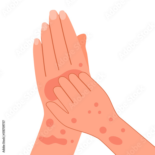Scratching hand and arm concept. Woman suffering from strong allergy skin itchy symptom in flat design. Red rash skin irritation. Monkeypox. photo