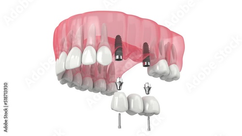 Upper jaw with dental bridge supported by implants 