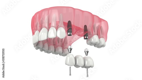 Upper jaw with dental bridge supported by implants  photo
